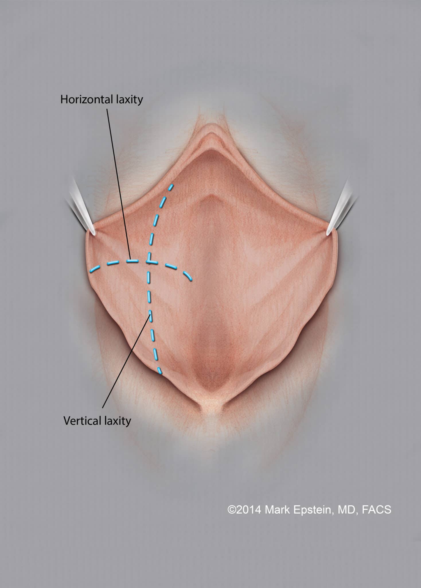Labiaplasty Long Island Labiaplasty Long Island