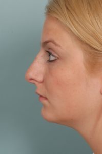 side profile of blonde woman after rhinoplasty nose surgery