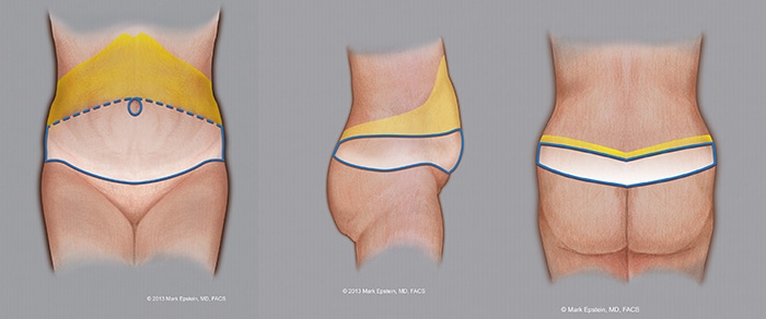 Belt Lipectomy Before and After 03