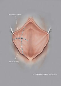 labiaplasty mark epstein md 2