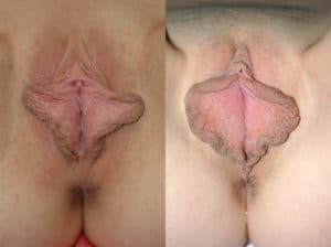 Excess Labia tissue