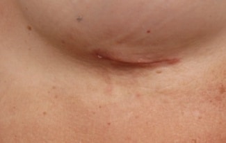 Breast Augmentation Scars: What to Expect