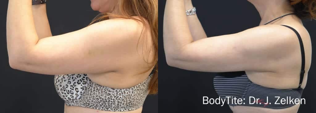 a2f88ab3fdd480f62c73892a2b4cc5b8.jz 1a bodytite arms 1024x366 1