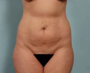 Before Image of Tummy Tuck Hauppauge NY