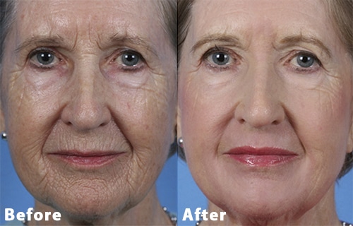 contour trl before after