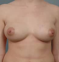 cr breast augmentation a f