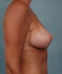 dd breast asymmetry p02 a s r