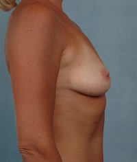 dd breast asymmetry p02 b s r