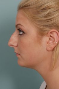 side profile of blonde woman before rhinoplasty nose surgery