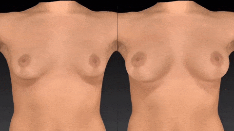 Two rotating topless female torsos side by side, with one on right having larger breasts after breast augmentation surgery