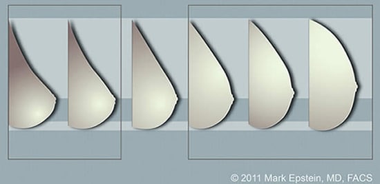 Breast Augmentation Sizing System