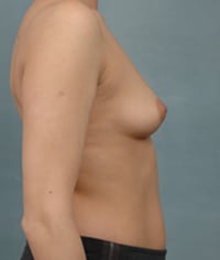 la breast asymmetry b s r