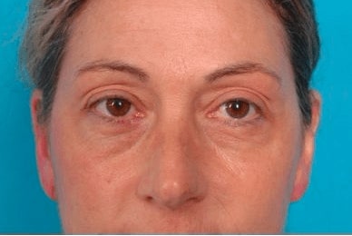 Before Eyelid Surgery Blepharoplasty Long Island Mark D. Epstein, MD