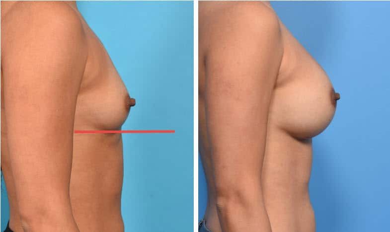 Will I Need a Breast Lift (Mastopexy)?