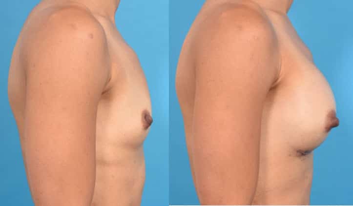 What causes a large gap between breasts after having had a breast  augmentation? (Photo)