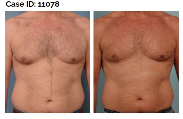 male patient’s bare chest before and after male breast reduction for gynecomastia