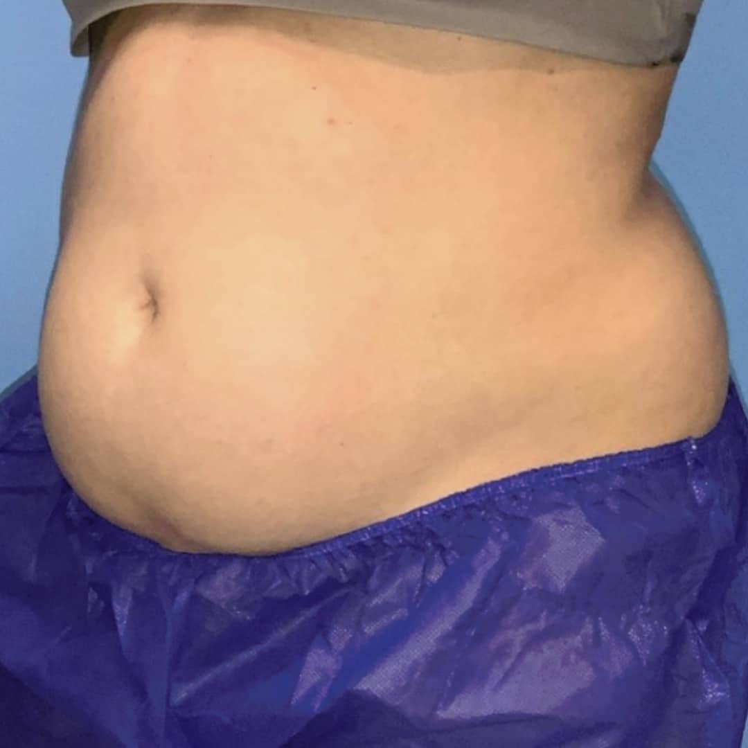 CoolSculpting