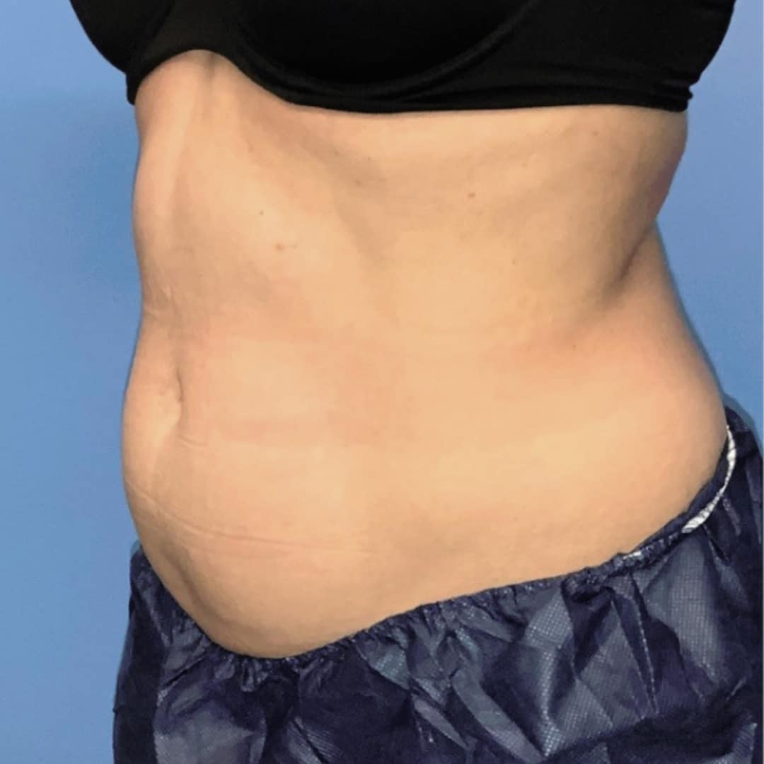 CoolSculpting