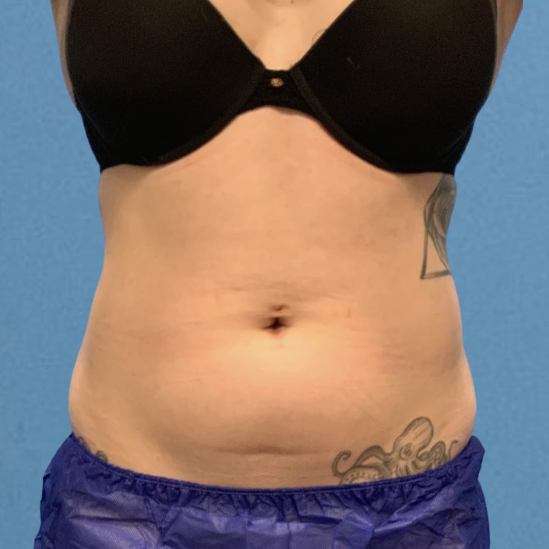 CoolSculpting