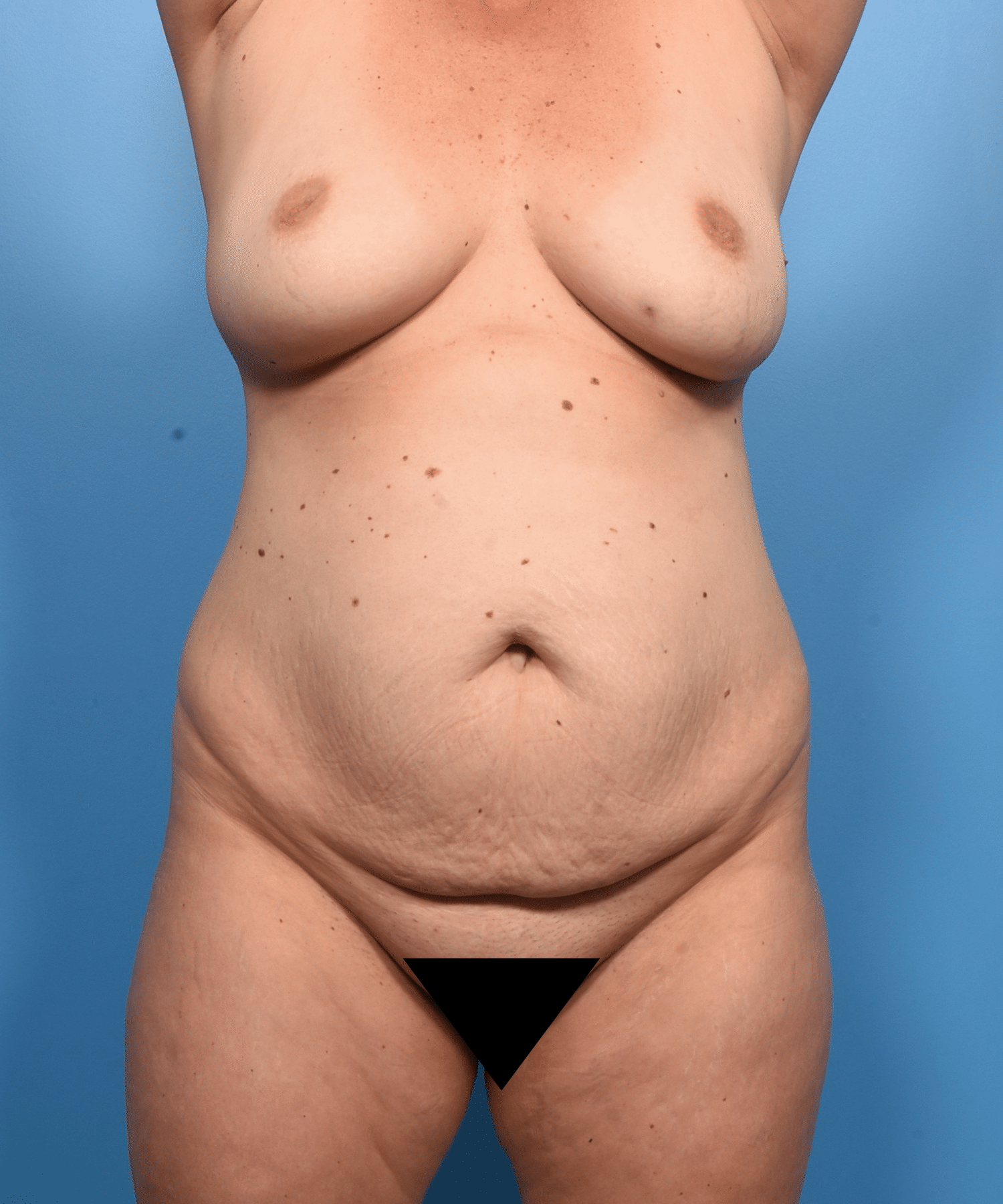 Before Image: Lipoabdominoplasty and lipo flanks and mons. - front