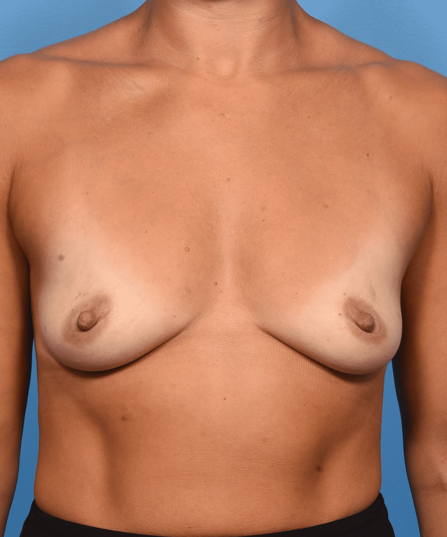 Breast Enhancement With Silicone Round “Gummy” Implants