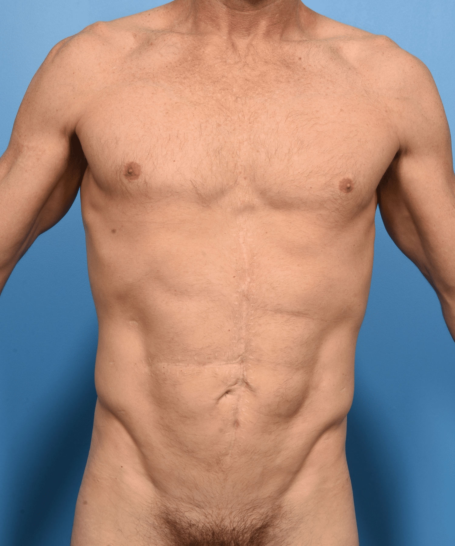 VASER lipo of abdomen and flanks