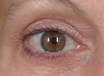 Blepharoplasty Long Island