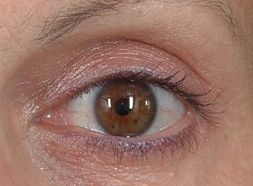 Blepharoplasty Long Island