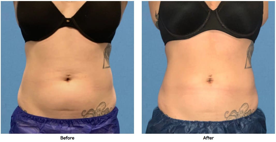 coolsculpting case