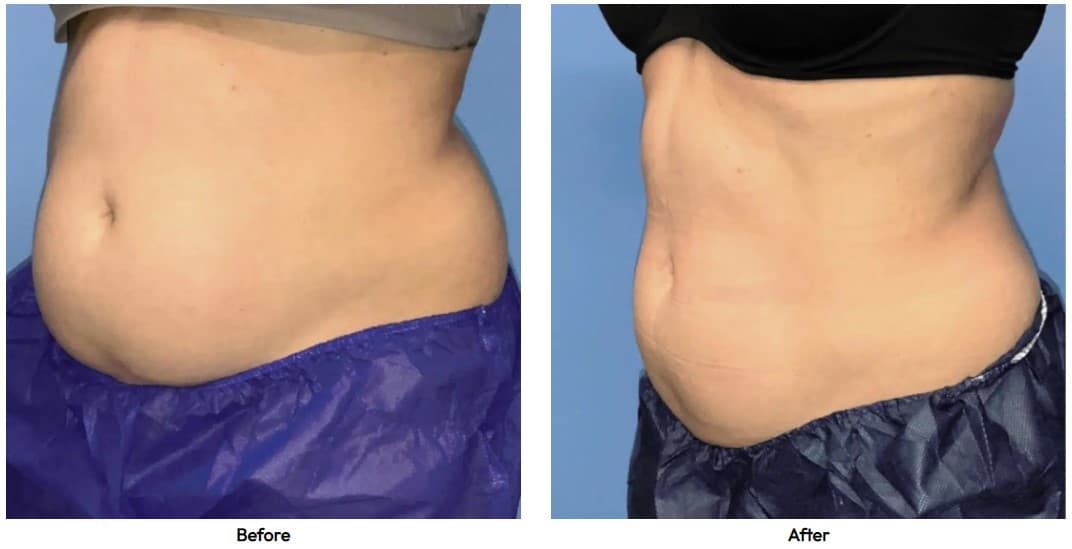 coolsculpting case