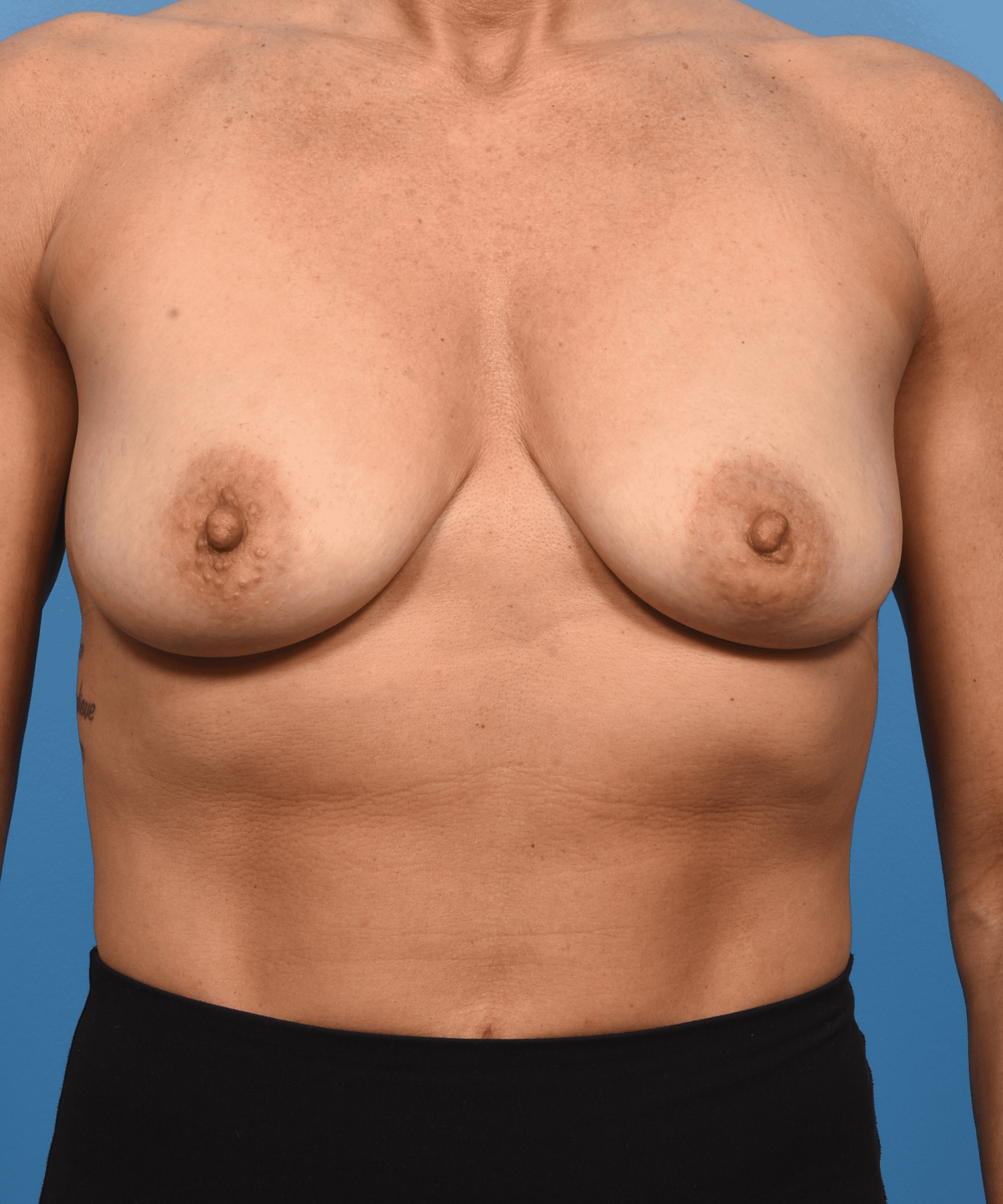 Breast Enhancement With Silicone Round “Gummy” Implants & Mastopexy (lift)