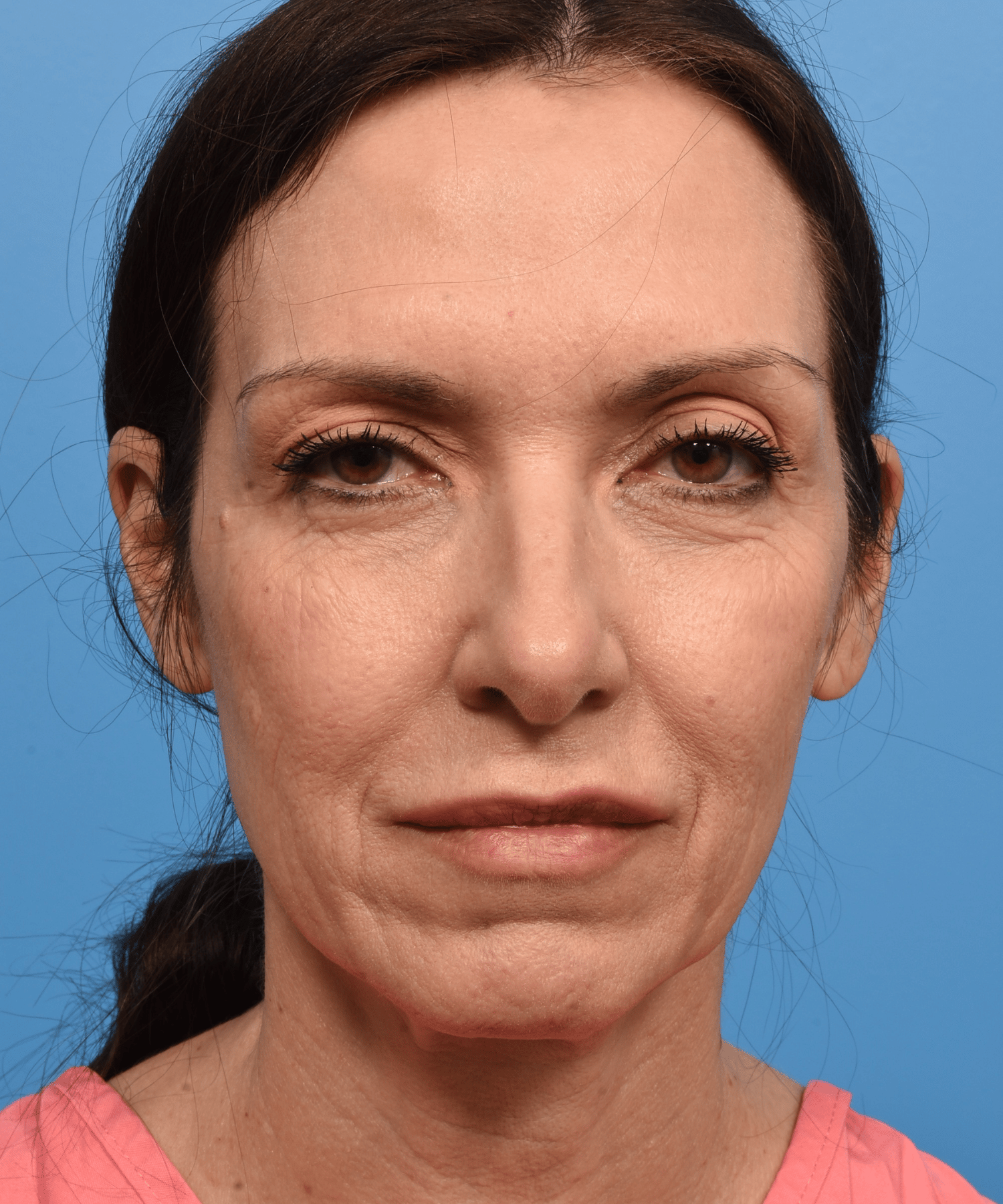 Facelift and Blepharoplasty with fat grafting
