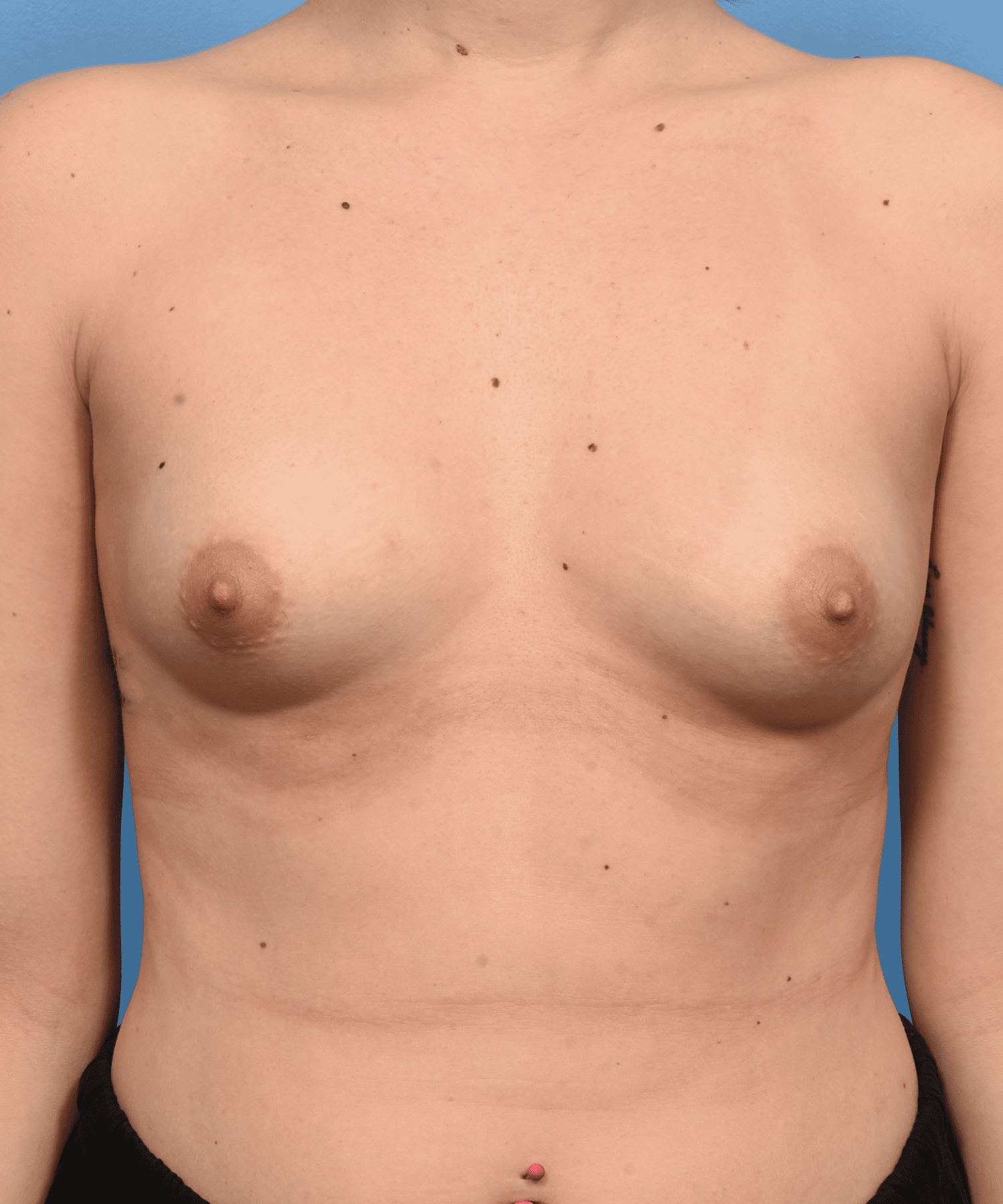 Breast Augmentation-non gummy