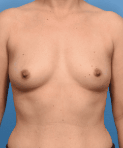 Breast Enhancement With Silicone Round Implants