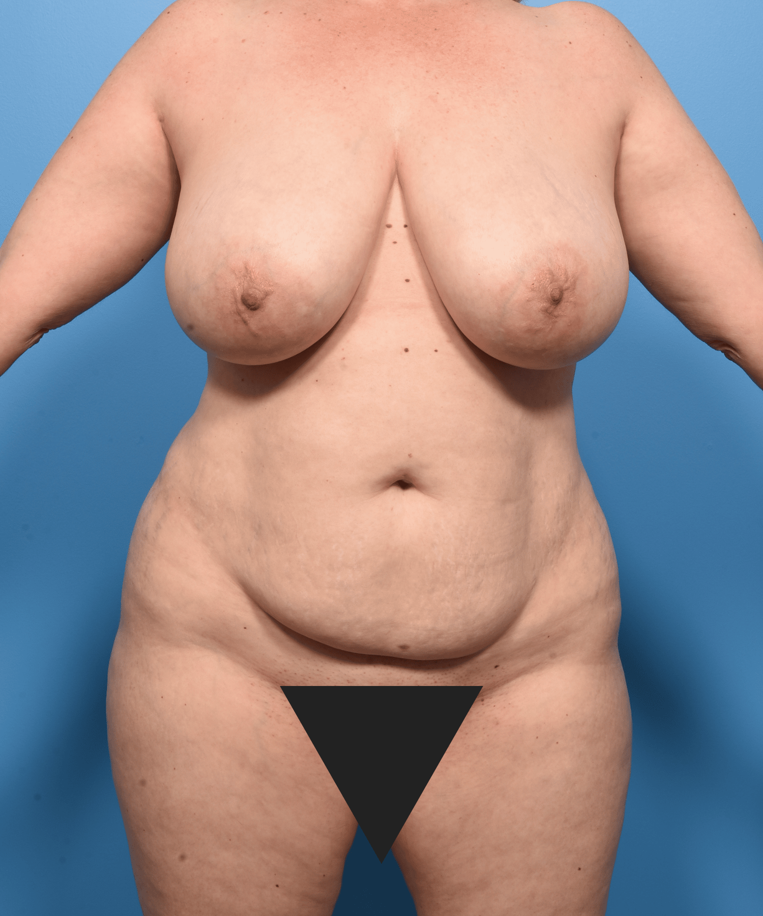 Abdominoplasty, Lipo abdomen, flanks, fat transfer to buttocks/hips