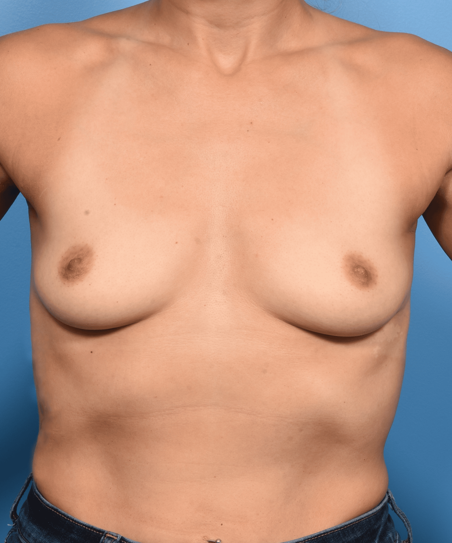 Breast Augmentation-Gummy