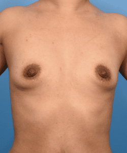 Breast Augmentation-Gummy