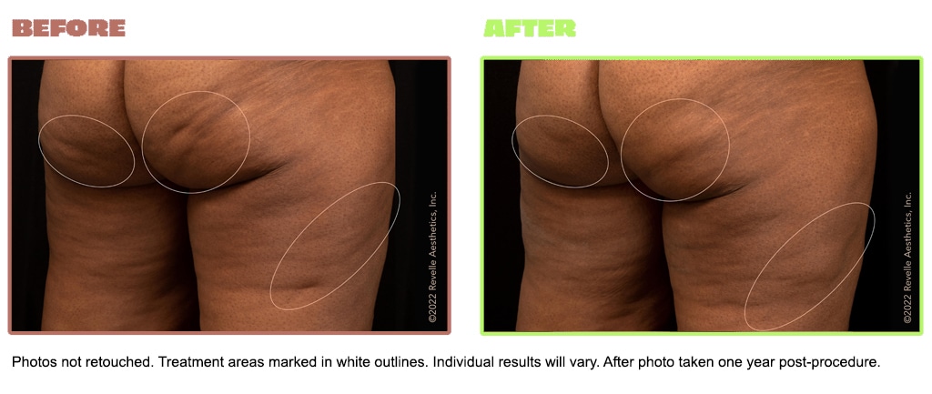 Avéli™ Cellulite Reduction Long Island - Epstein Plastic Surgery