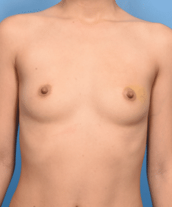 Breast Augmentation- Non Gummy