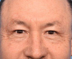 Eyelid Surgery (Blepharoplasty)