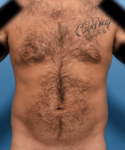 Liposuction to abdomen, chest, flanks, Renuvion of flanks with fat transfer to pectoral muscle