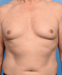 Gynecomastia