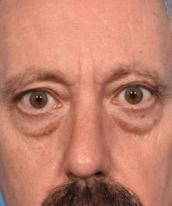 Four Eyelid Blepharoplasty with Lateral Canthopexy