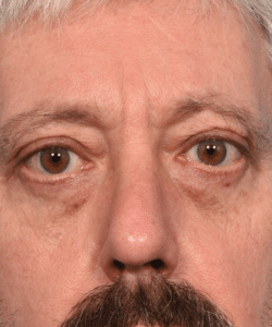 Four Eyelid Blepharoplasty with Lateral Canthopexy