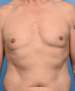 Gynecomastia