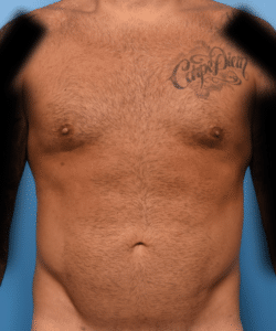 Liposuction to abdomen, chest, flanks, Renuvion of flanks with fat transfer to pectoral muscle