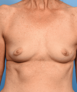 Breast Augmentation-Non-Gummy