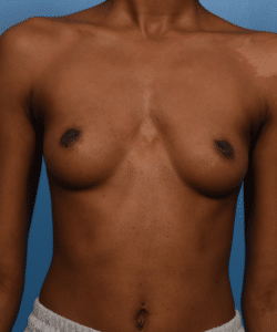 Breast Augmentation-Gummy