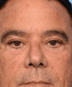 Four Eyelid Blepharoplasty