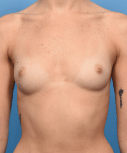 Breast Augmentation-Non Gummy with Inverted Nipple repair